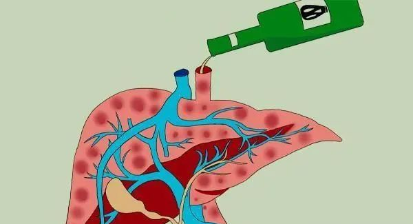 男子因饮酒过度致肝衰竭，职场应酬需警惕健康危机